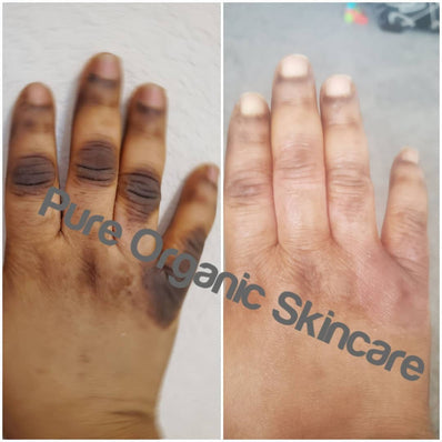 Pure organic skincare dark knuckle remover